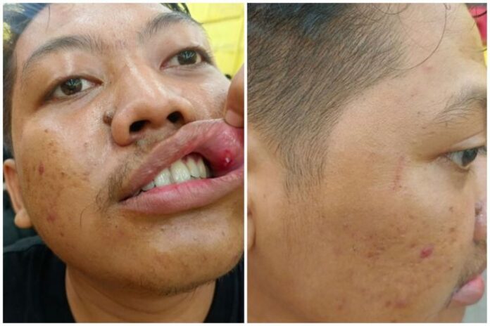 Jurnalis Beritajatim.com, Rama Indra Surya Permana, menunjukkan luka yang dialaminya